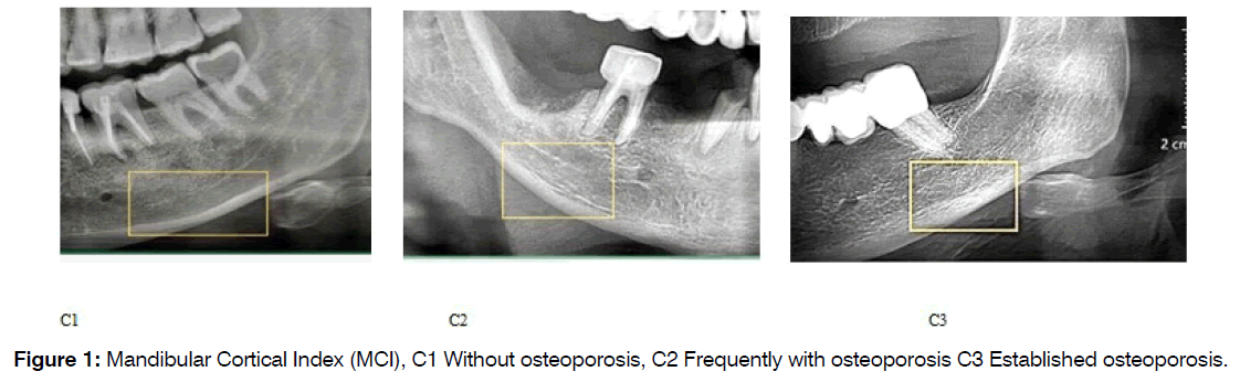 tinnitus-established-osteoporosis