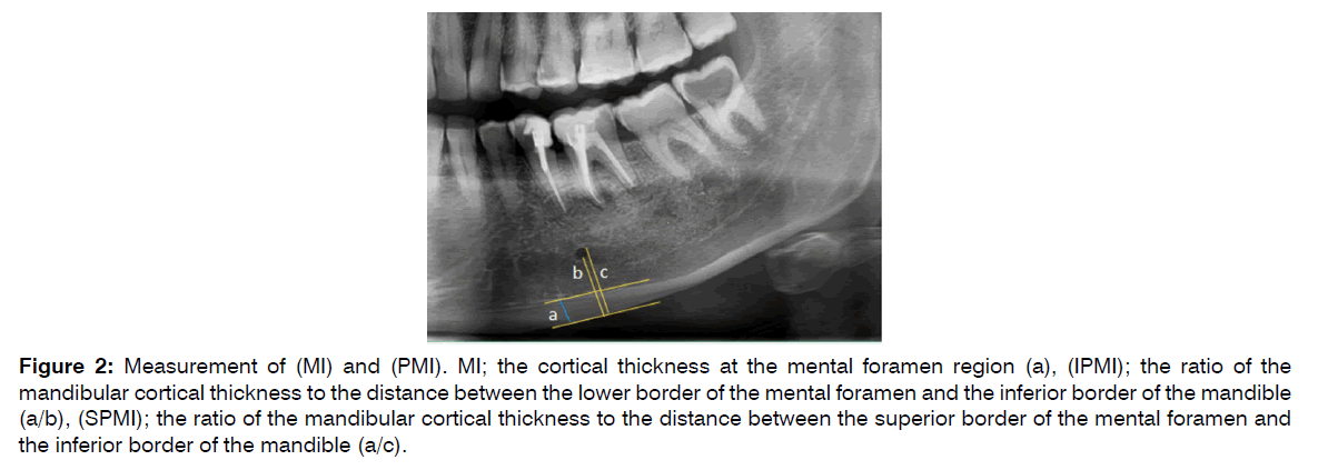 tinnitus-established-osteoporosis